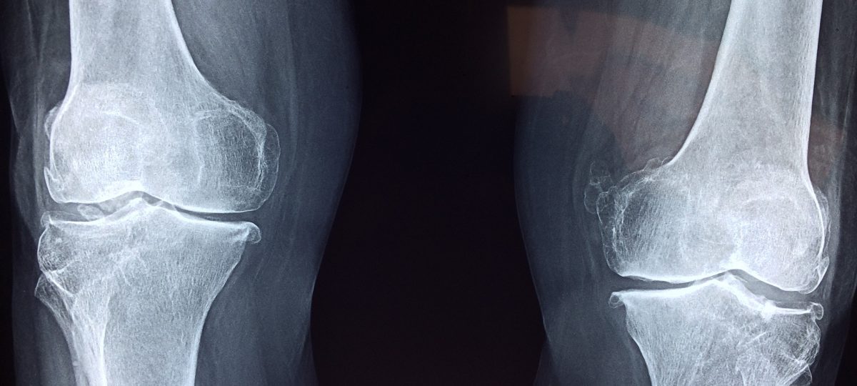 Orthopaedic Surgery Negligence Claims